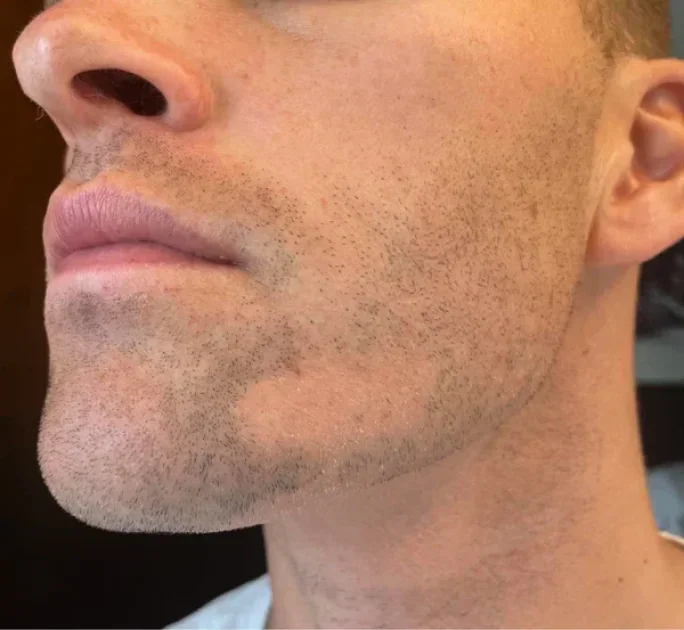 Minoksidil ile Sakal Çıkarmak: Gerçekler ve Riskler